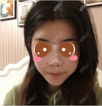 记录我花六千在北京艺星做无痕内切缩鼻翼二十八天恢复图