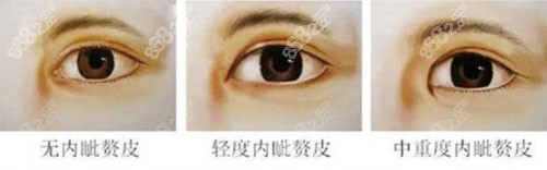 上海御颜整形眼综合术适应症