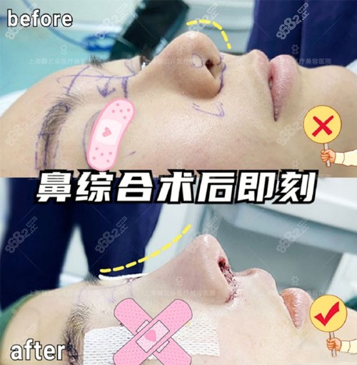 上海馥兰朵肋软骨隆鼻术后即刻真人照片