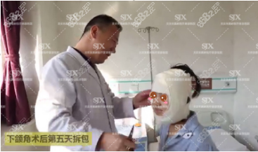 北京圣嘉新张笑天下颌骨瘦脸真人案例术后第五天
