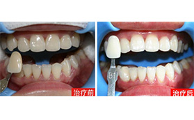 三亚口腔医院向亚东牙齿美白案例