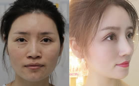 我的肋骨鼻和全脸脂肪填充经历:看衡阳美莱邓颖技术怎么样?