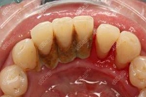 牙龈炎初期会有什么症状牙龈炎可以自愈吗