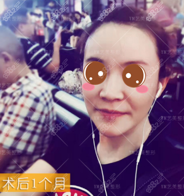 北京艺美王东自体脂肪面部填充失败修复真人案例术后三十天