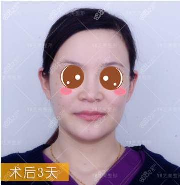 北京艺美王东自体脂肪面部填充失败修复真人案例术后第三天