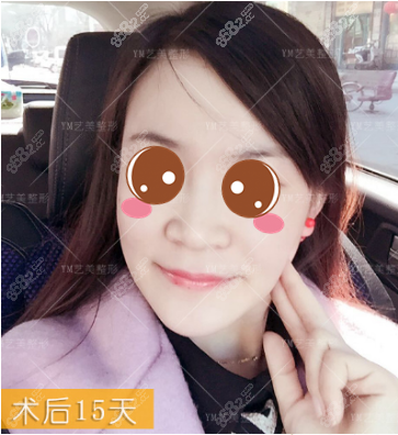 北京艺美王东自体脂肪面部填充失败修复真人案例术后十五天