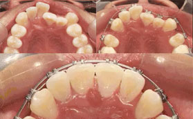 上海伊莱美口腔医院金属托槽自锁牙齿矫正对比照片