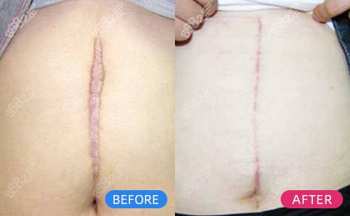 上海清沁医疗美容SRT-100治疗剖腹部手术疤痕对比