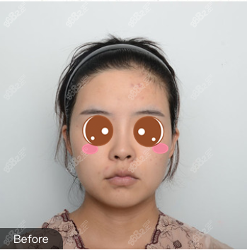 北京艺美王东面部吸脂+自体脂肪面部填充真人案例术前照