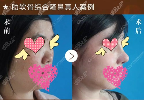 术前术后鼻子对比