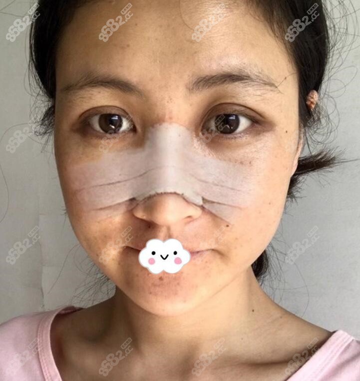 深圳自体肋软骨隆鼻术后3天恢复图