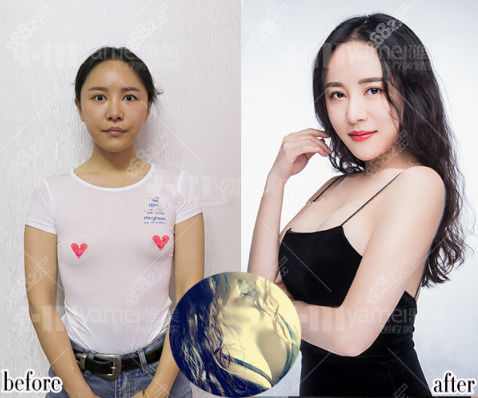 曼托260假体隆胸恢复图片见证雅美是不长沙前3隆胸整形医院