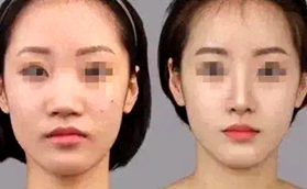 南京鼻祖四维榫卯综合鼻，相比自体肋软骨隆鼻有何优势？
