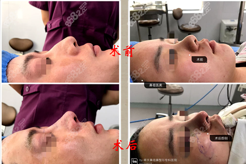 南京鼻祖四维榫卯综合鼻术后即刻前后对比图