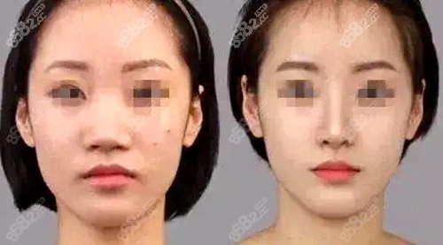 南京鼻祖四维榫卯综合鼻术前术后对比图