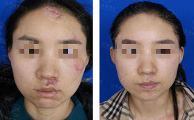 在武汉正璞疤痕整复医疗花费了1万多终于拯救了我脸上的疤
