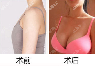 北京华韩假体隆胸真人案例对比图