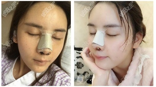 南京鼻祖医疗美容张哲做自体耳软骨隆鼻案例术后3天样子
