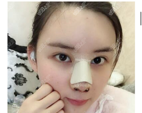 南京鼻祖医疗美容张哲做自体耳软骨隆鼻术后恢复图