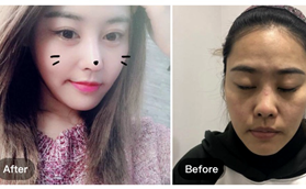南京康美美容医院冯思阳膨体隆鼻手术案例分享