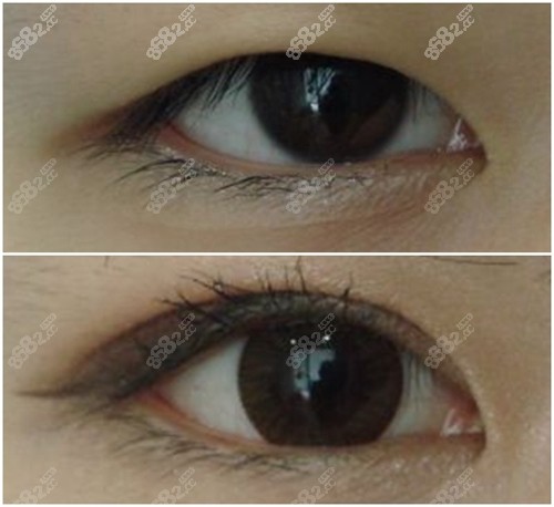 双眼皮术前术后对比照