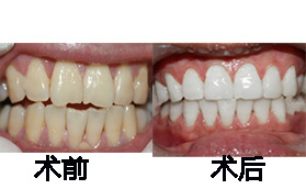 长沙星雅整形医院牙齿冷光美白案例