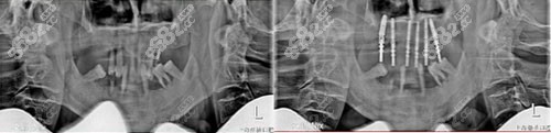 上海鼎植永博口腔快速半口种植牙CT对比