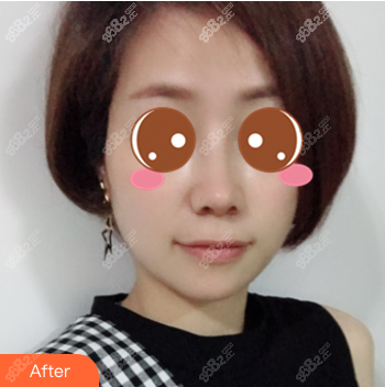 北京薇琳鼻综合真人案例术后三十二天