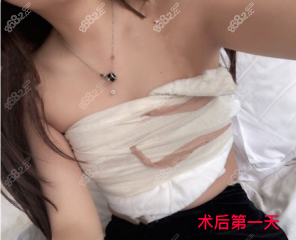 北京八大处穆大力自体脂肪隆胸术后照