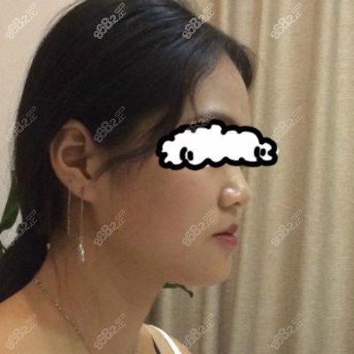 我找重庆联合丽格党宁做鼻子前照片