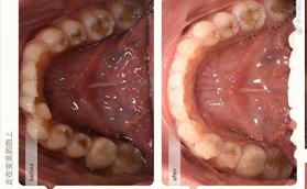 ​经过太原众牙1年的隐形牙齿矫正感觉隐适美的缺点就是贵
