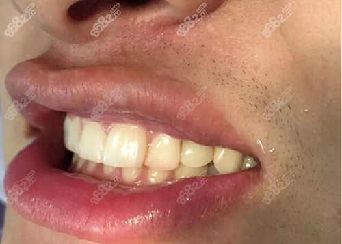 巴中白玉牙科真人案例让你直观感受种植牙哪个步骤较痛苦