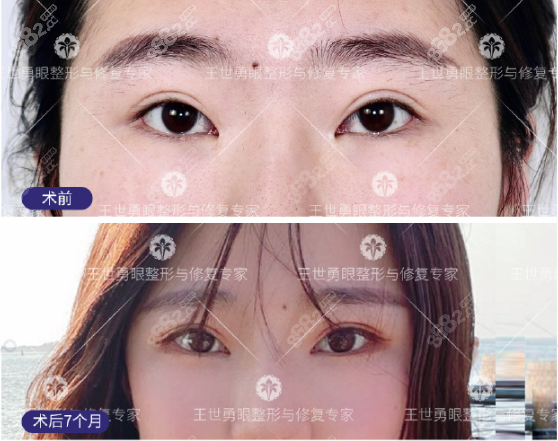 北京东方百合王世勇双眼皮修复+内眼角修复案例对比图