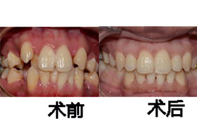湖南长沙牙祖口腔医院自锁托槽牙齿矫正案例