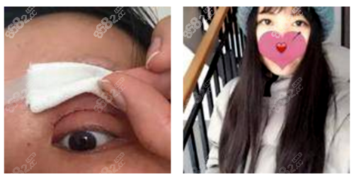 南京维多利亚美容医院刘健切开双眼皮手术案例术前样子