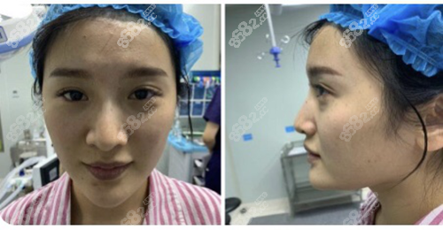 南京河西美容医院宿培龙硅胶隆鼻修复案例术前样子