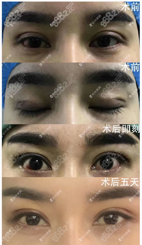 主推郑州郑东美眼整形,原河南省机关直属第二医院