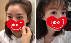 她在遵义韩美整形医院做了双眼皮手术,全程案例前后对比图