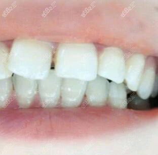 在深圳口碑好的口腔牙科诊所做舌侧矫正真实经历
