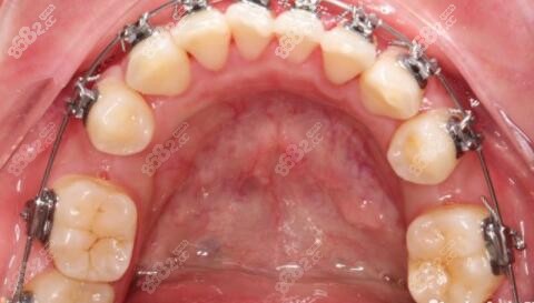 做金属自锁矫正牙齿4个月效果照