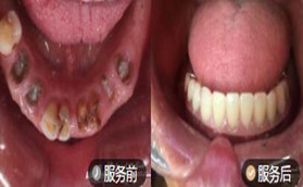 盘锦奥泰口腔半口种植牙真人案例前后效果对比照展示！