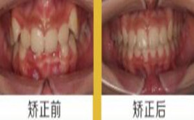 盘锦牙博士口腔金属直丝托槽牙齿矫正真人前后对比效果照
