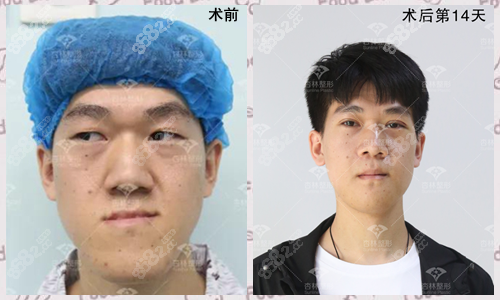 歪脸男孩在沈阳杏林做面部综合整形术前和术后14天对比照