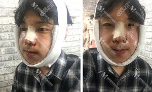 韩国迪美轮廓三件套+鼻综合术后三天