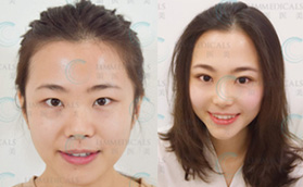 北京日式双眼皮哪家好?在领医做日式无痕双眼皮效果获好评