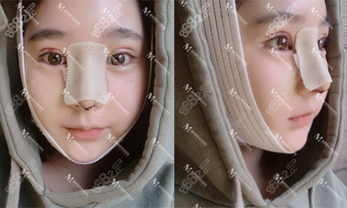韩国迪美THE-M整形医院眼鼻+线提升+面吸+轮廓三件套术后一周