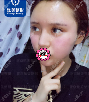 北京炫美自体脂肪面部填充真人案例图2