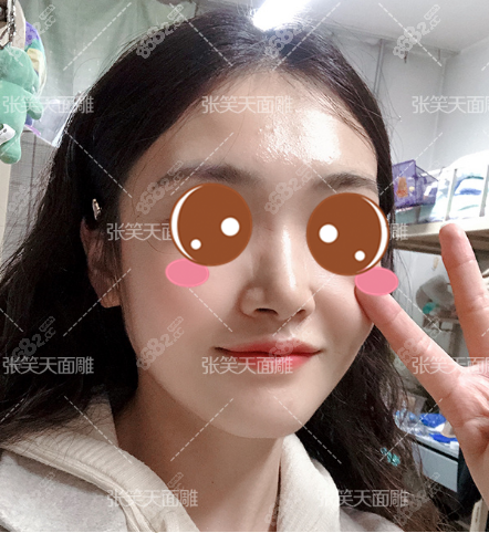 下颌成角截骨+祛外板术后三个月 下颌成角截骨+祛外板术后三个月