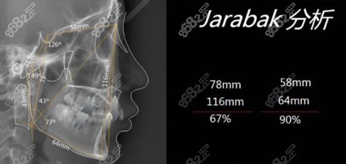 上海维乐口腔正畸jarabak分析方案 上海维乐口腔正畸jarabak分析方案