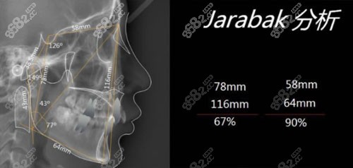 上海维乐口腔正畸jarabak分析方案